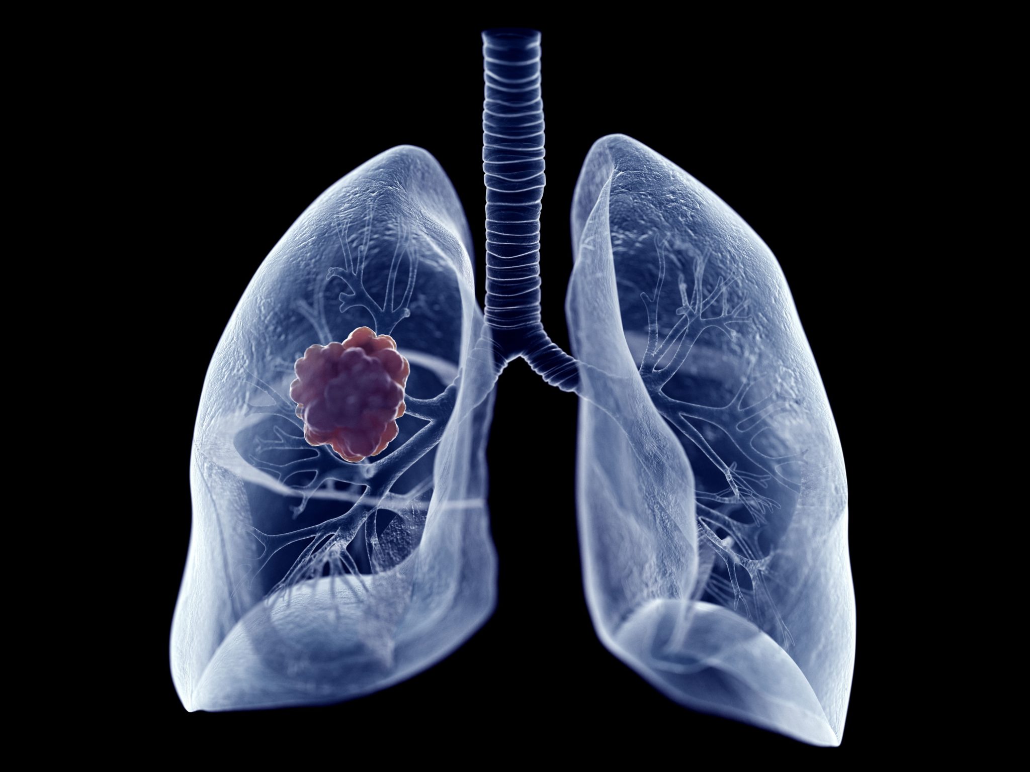 Cáncer de pulmón