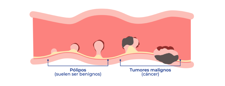 Pólipos y Tumores