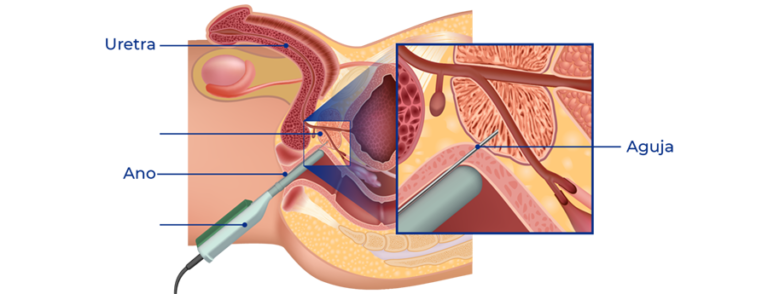 Biopsia prostática
