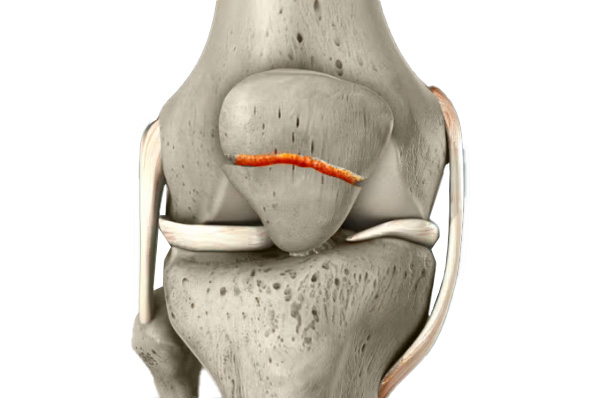 Hueso fracturado