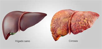 Cirrosis hepática