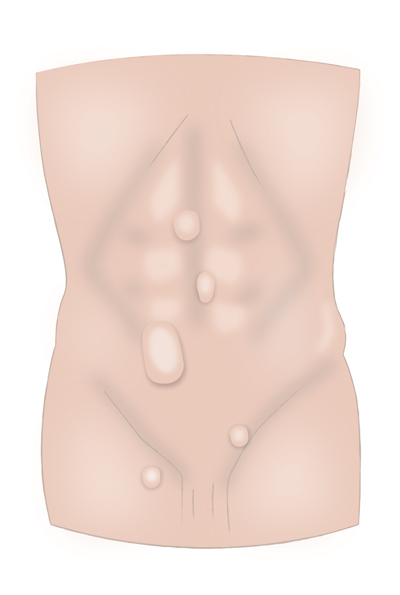 Hernia