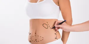 ¿Cuándo realizar una abdominoplastía?