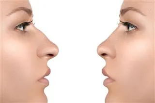 Rinoplastia