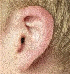 Auriculoplastía