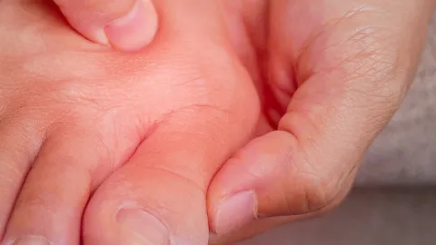 Hallux Valgus