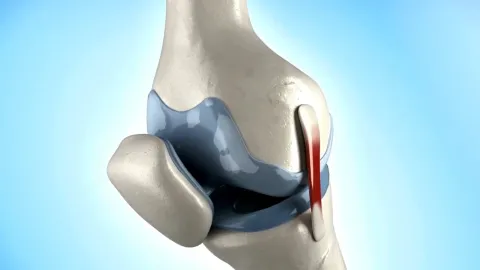 Desgaste de cartílago de rodilla