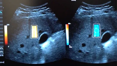 Elastografía por ultrasonido