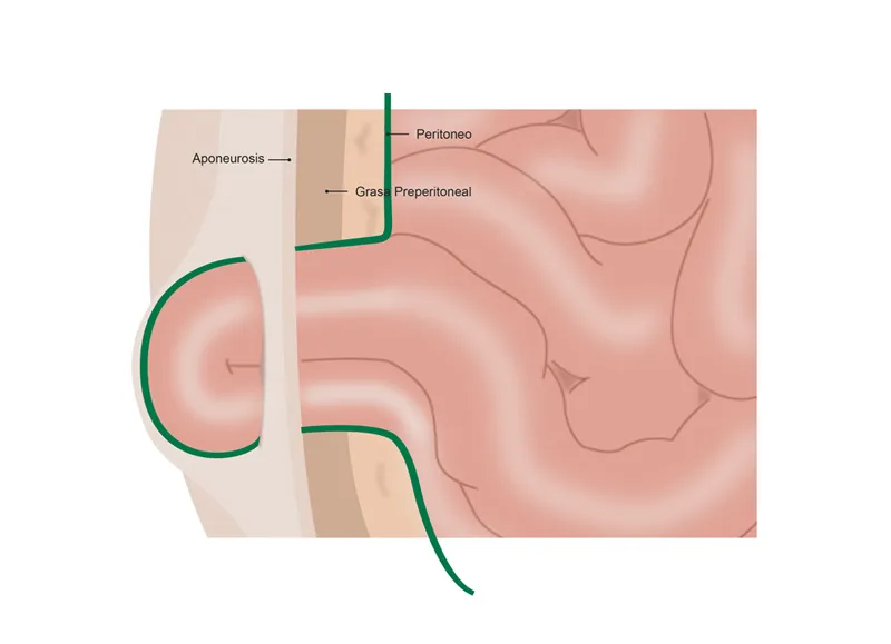 Hernia