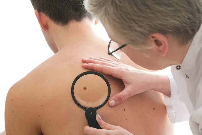 Lunares sospechosos: ¿Cuándo debo preocuparme?