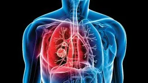 Qué es la Tuberculosis y cómo debe tratarse
